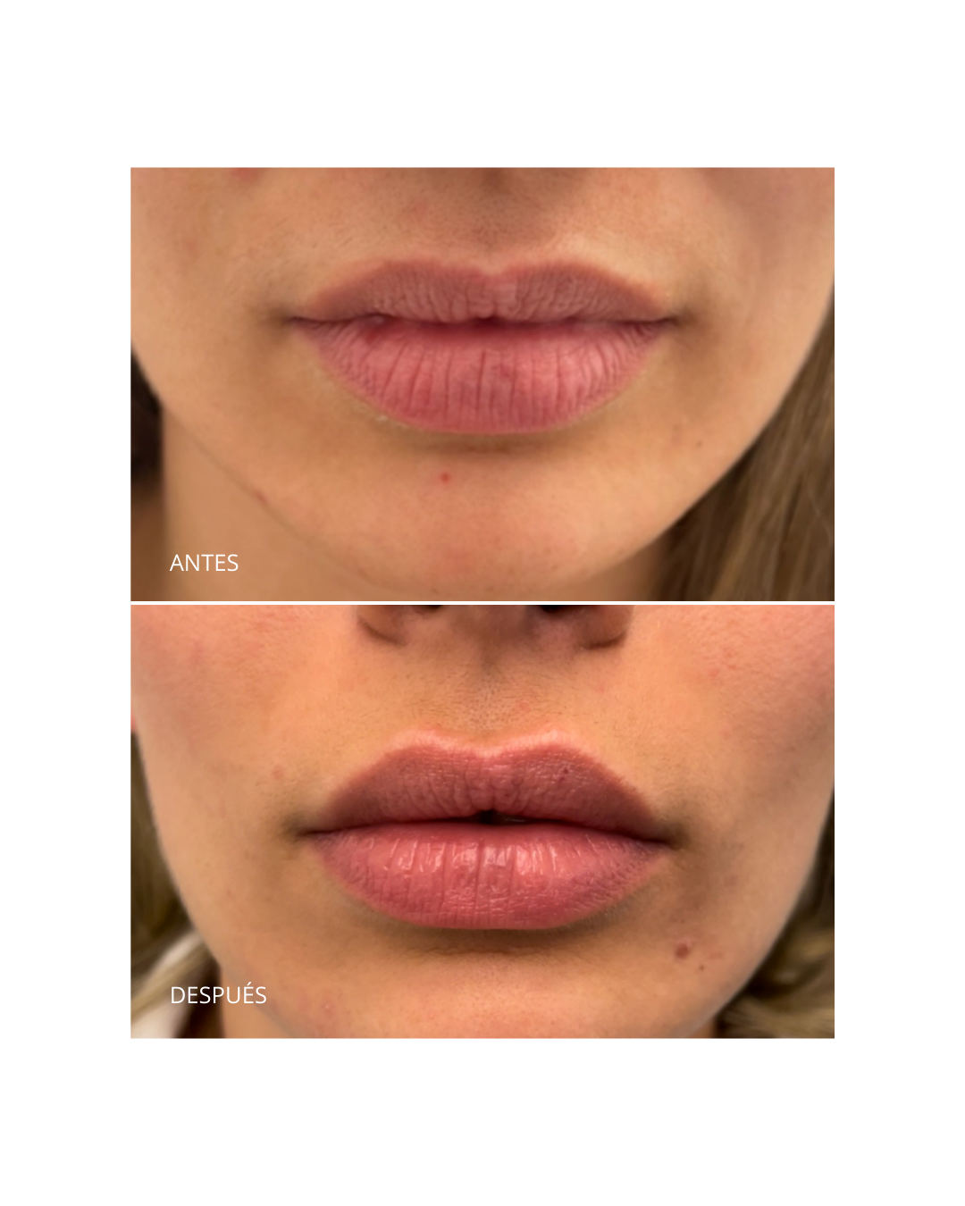 Aumento/ hidratación de labios