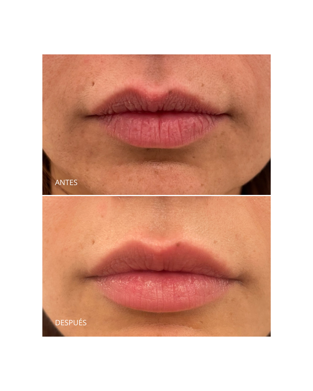 Aumento/ hidratación de labios