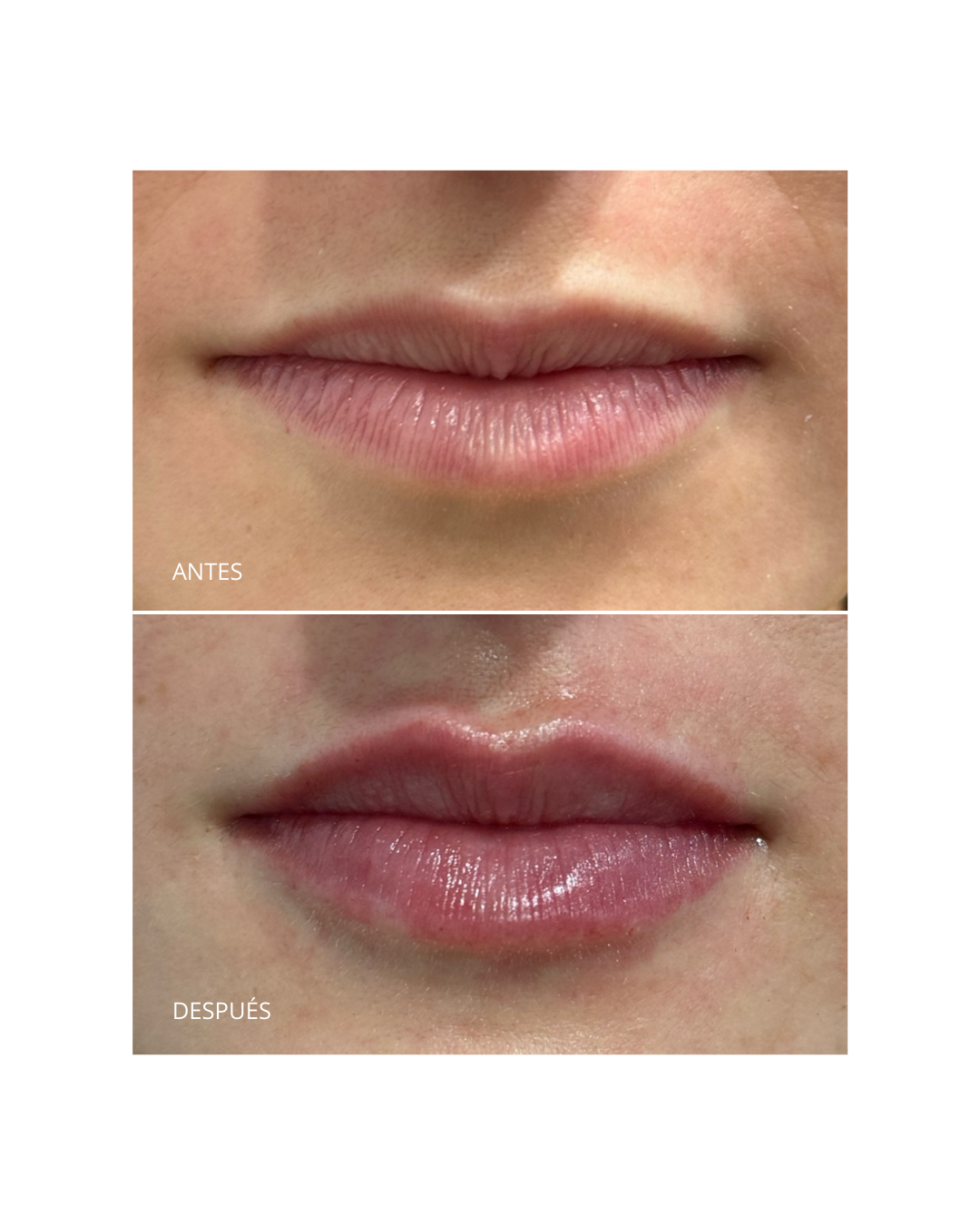 Aumento/ hidratación de labios
