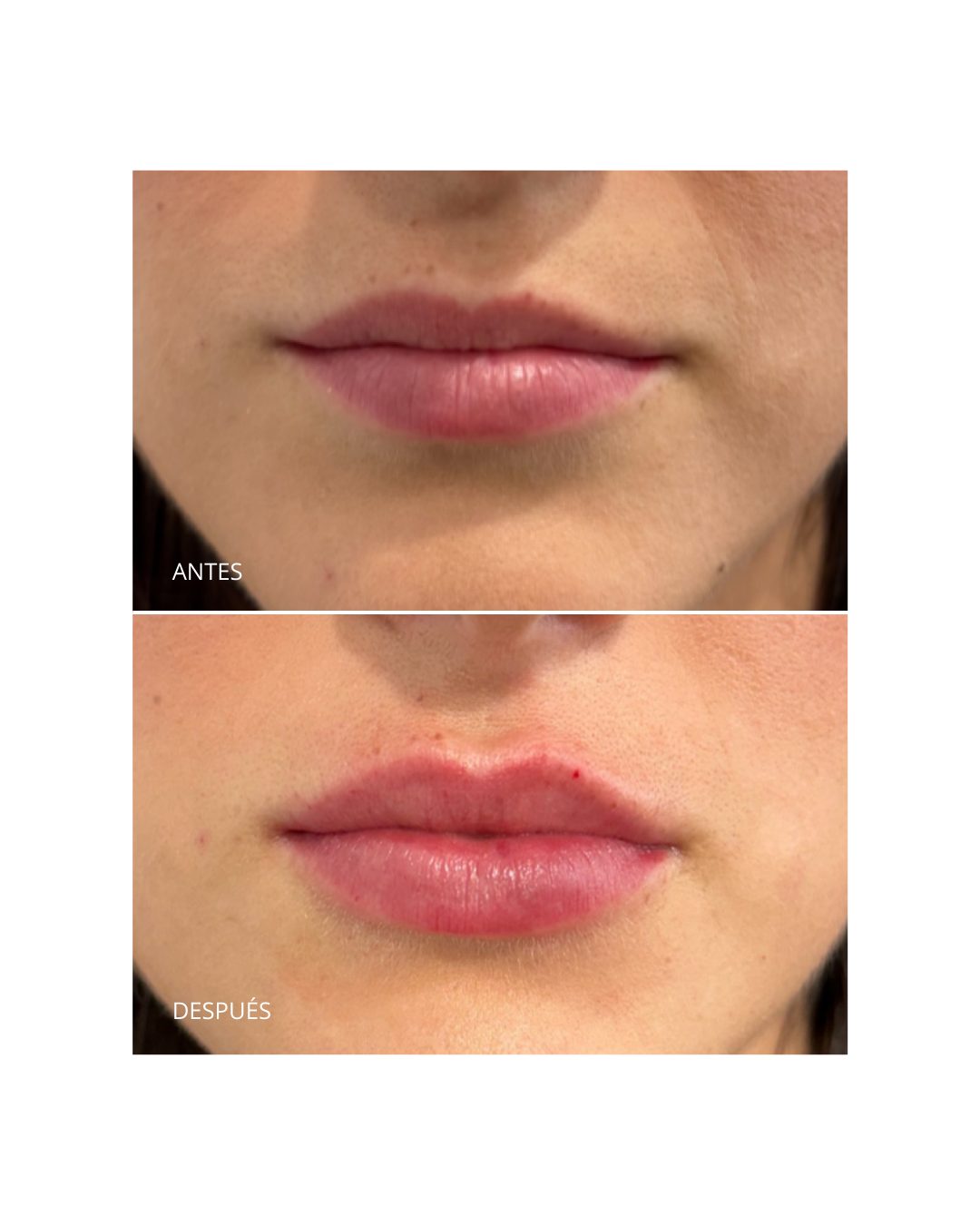 Aumento/ hidratación de labios