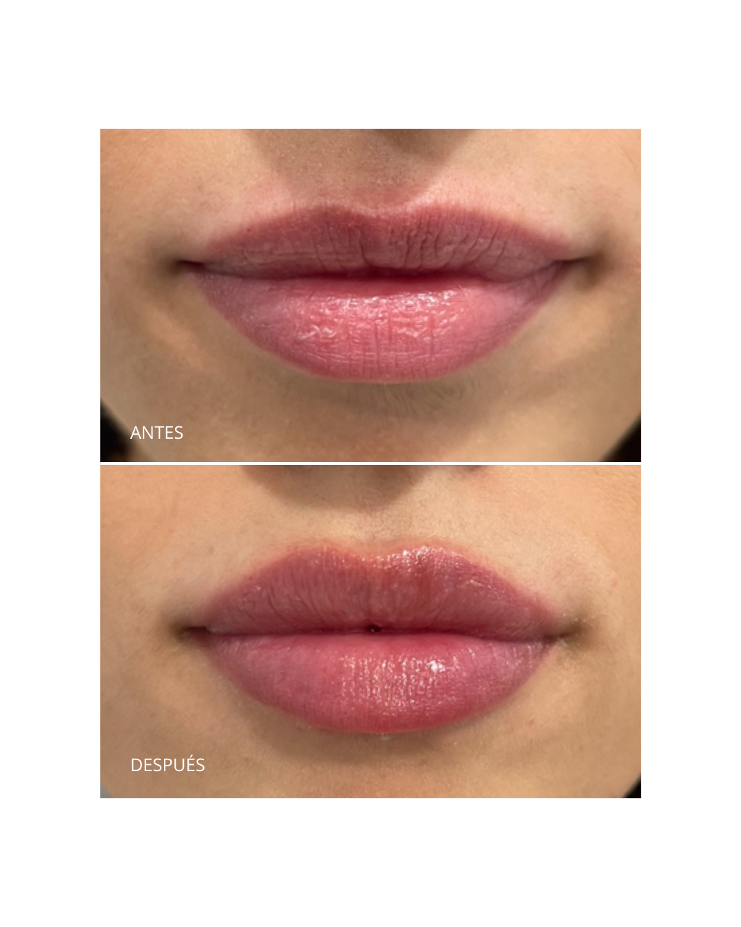 Aumento/ hidratación de labios