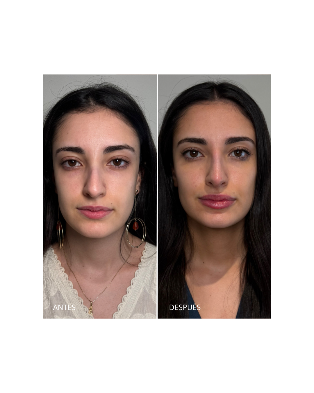 Armonización facial