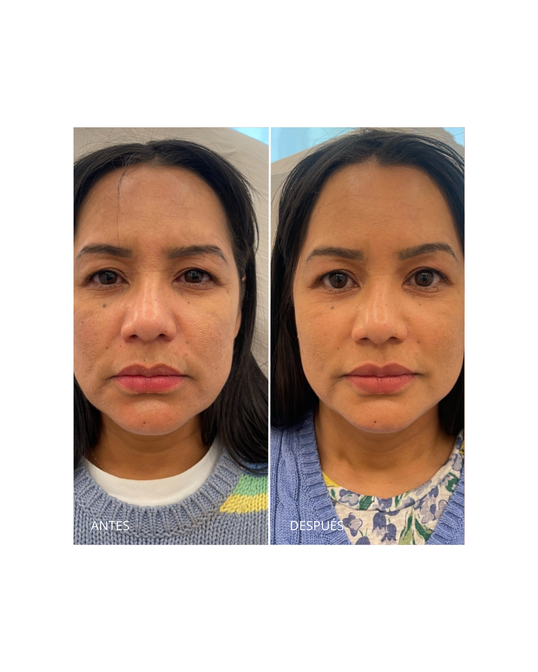 Armonización facial