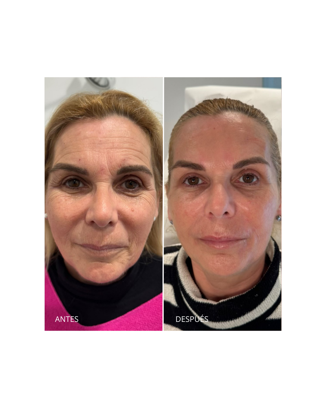 Armonización facial
