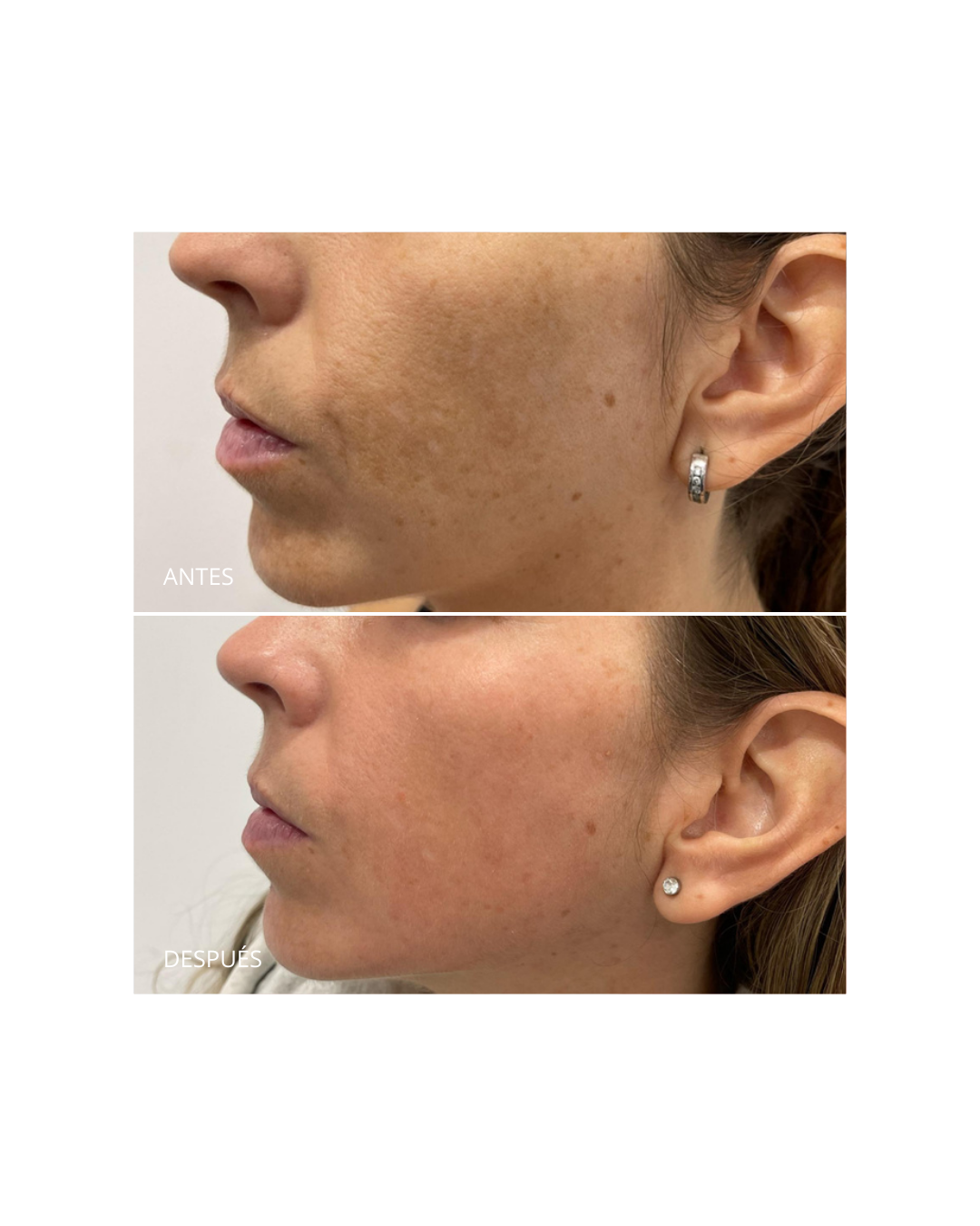 Pack Despigmentante. Dermamelan