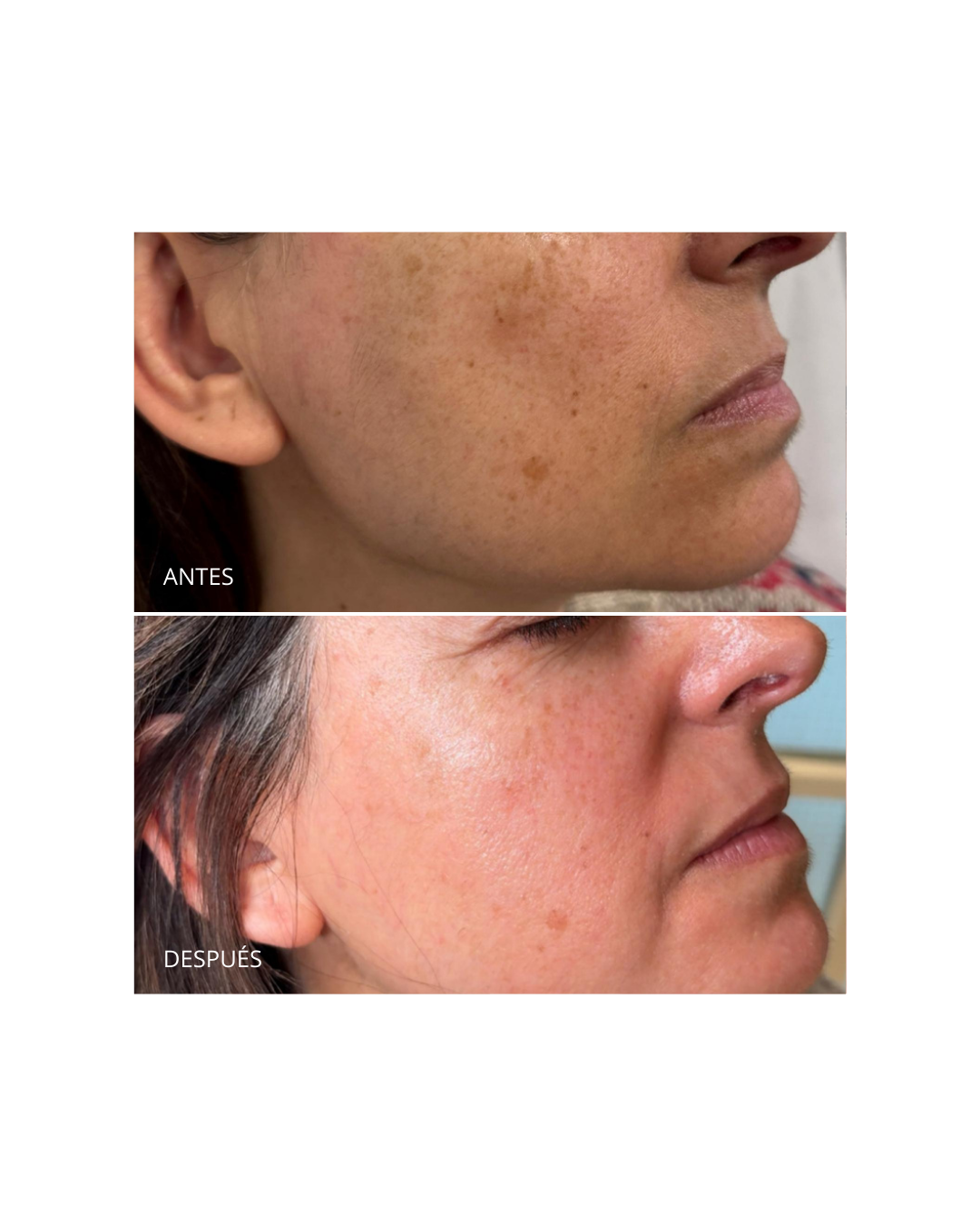 Pack Despigmentante. Dermamelan