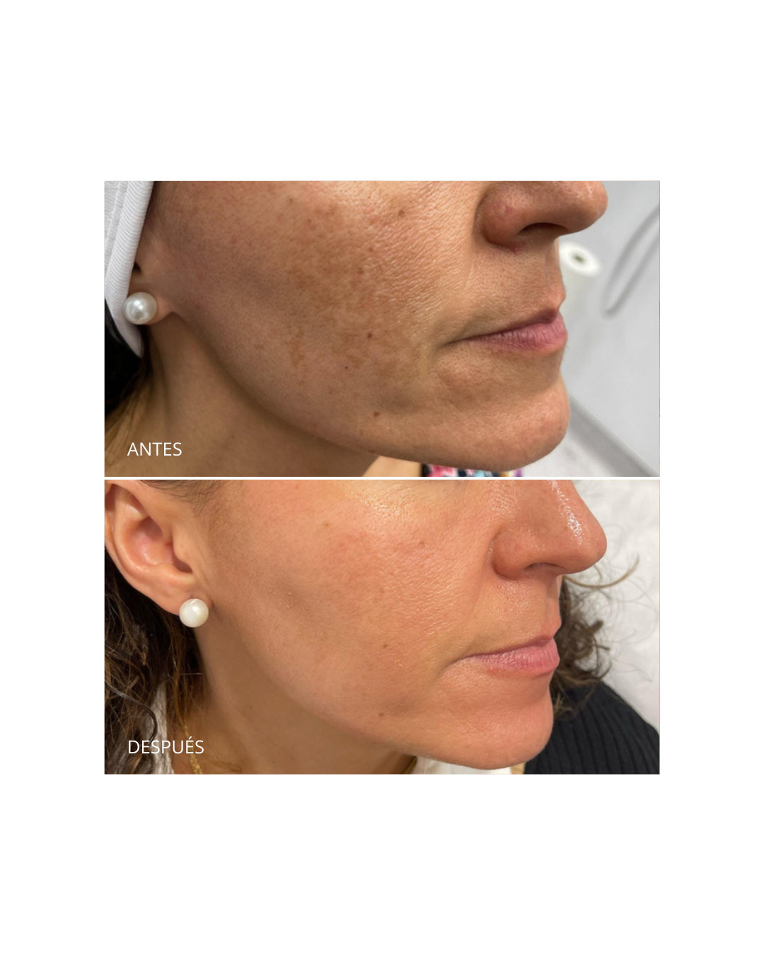 Pack Despigmentante. Dermamelan