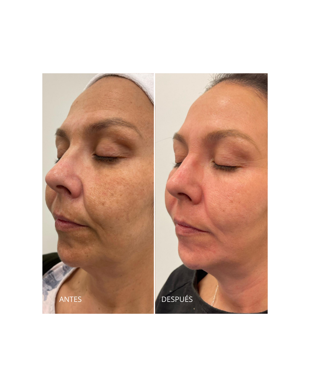 Pack Despigmentante. Dermamelan