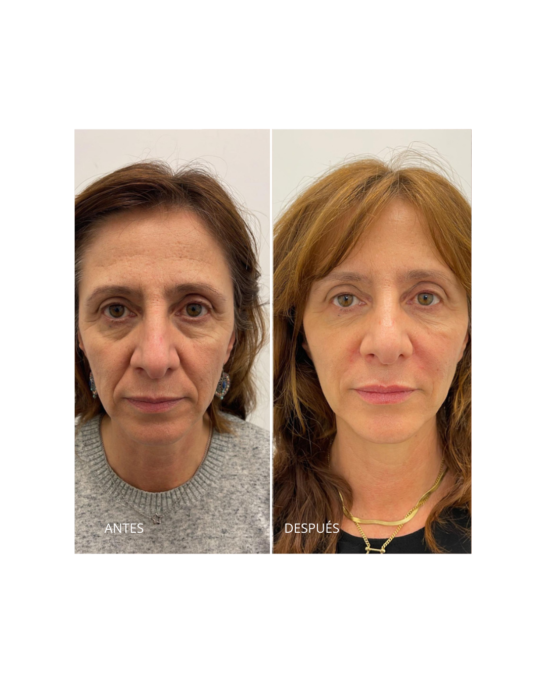 Armonización facial