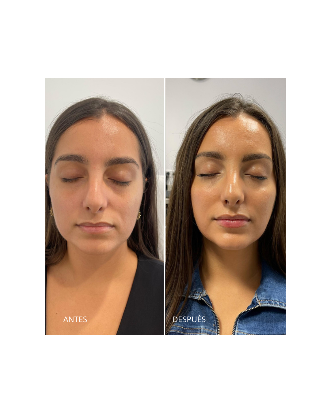 Reposición de Pómulo