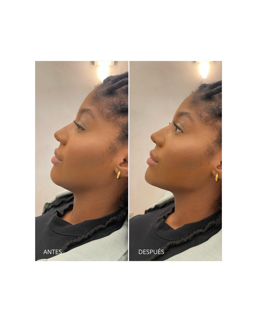 Reposición de Pómulo