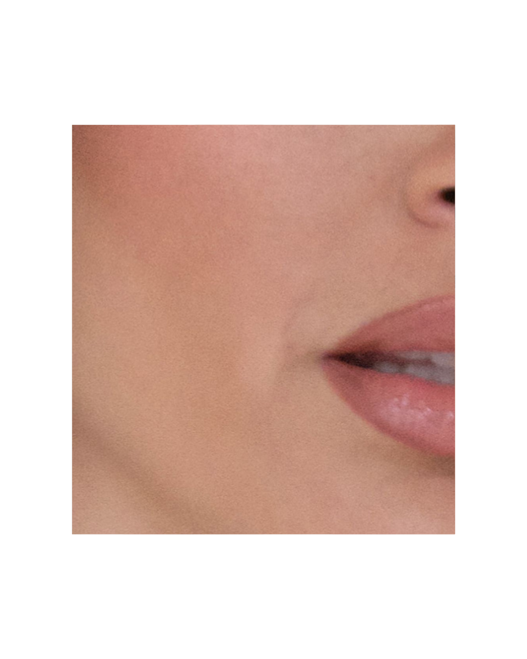 Dermapen con exososmas