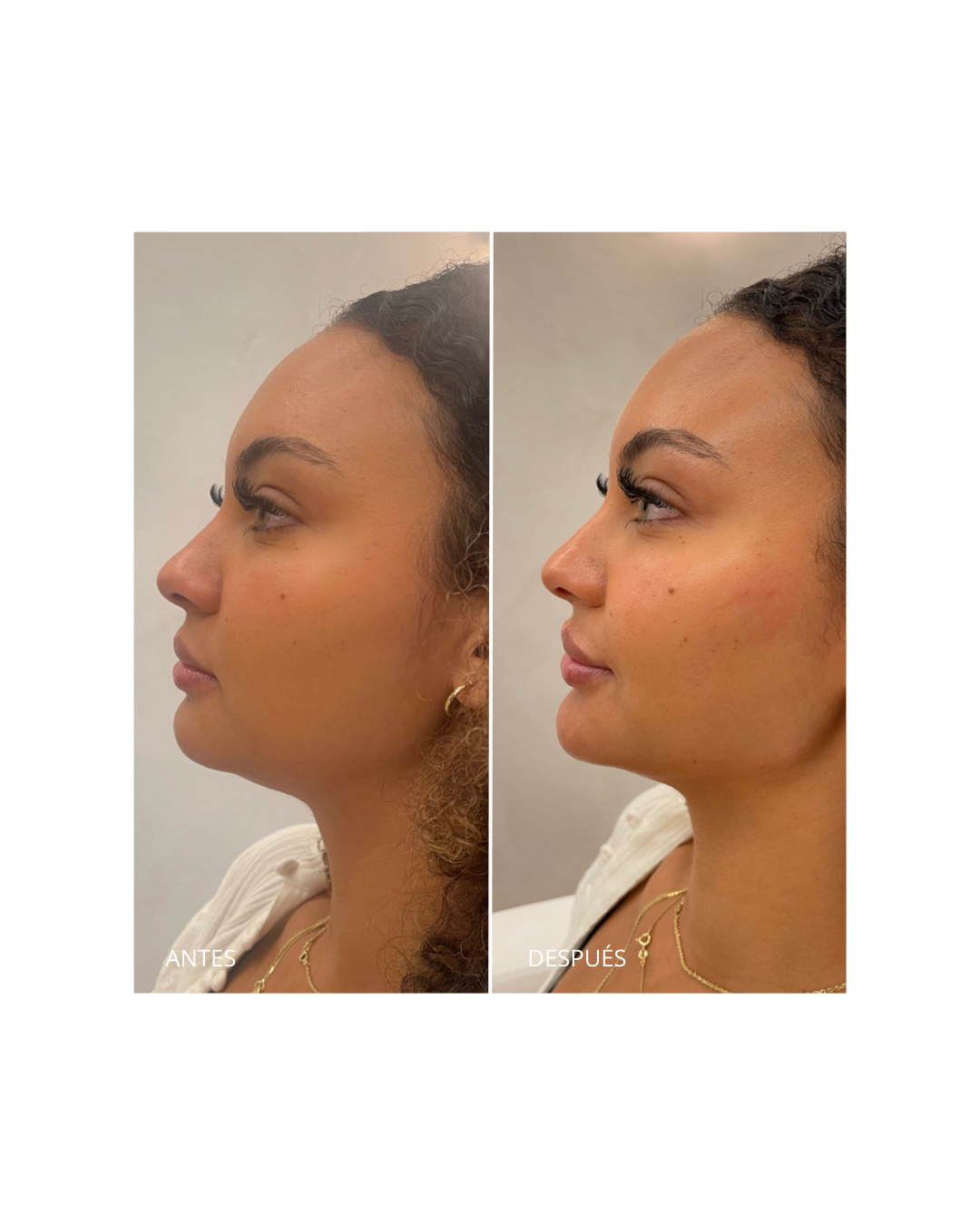 Marcación Mandibular