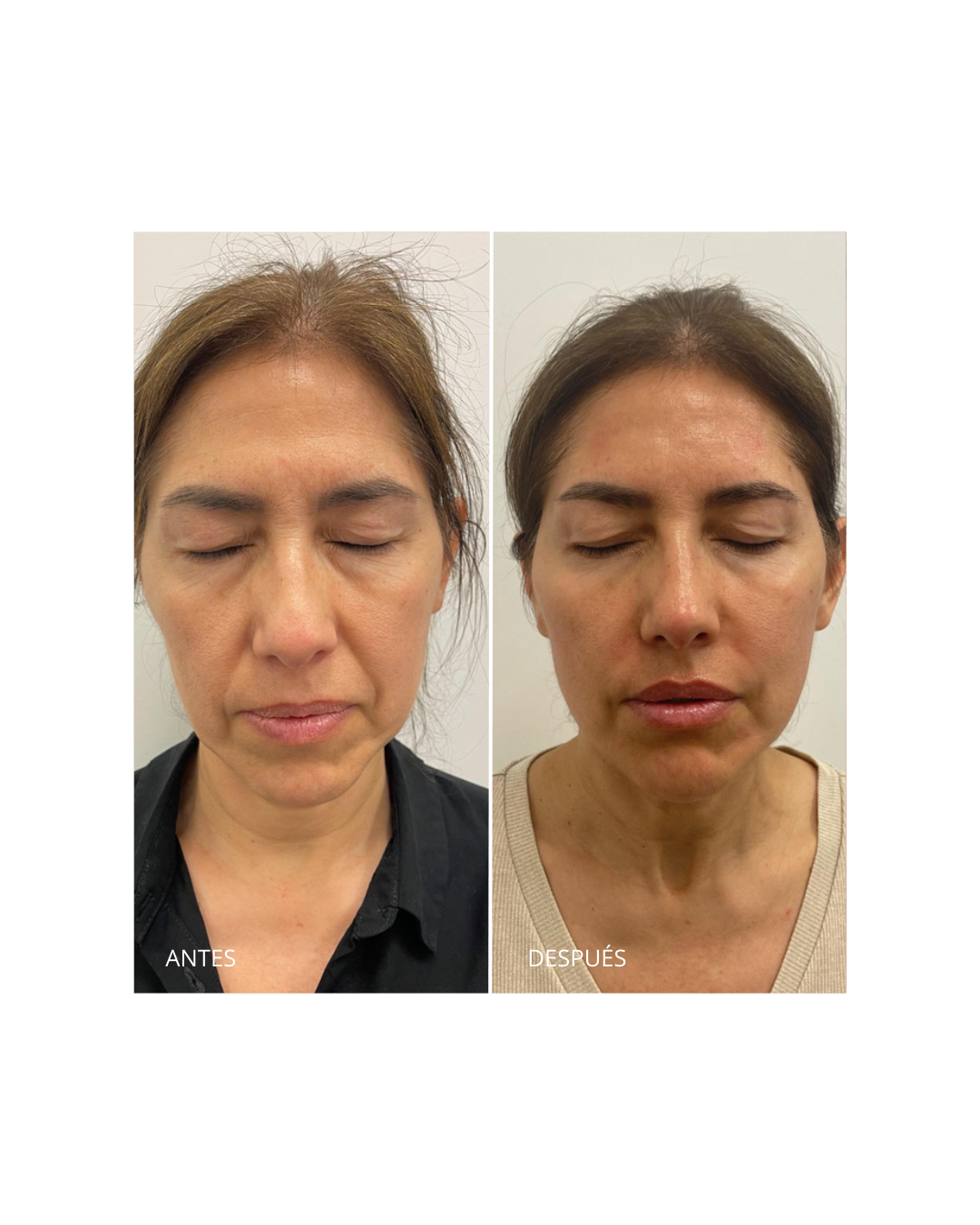 Corrección del surco nasogeniano