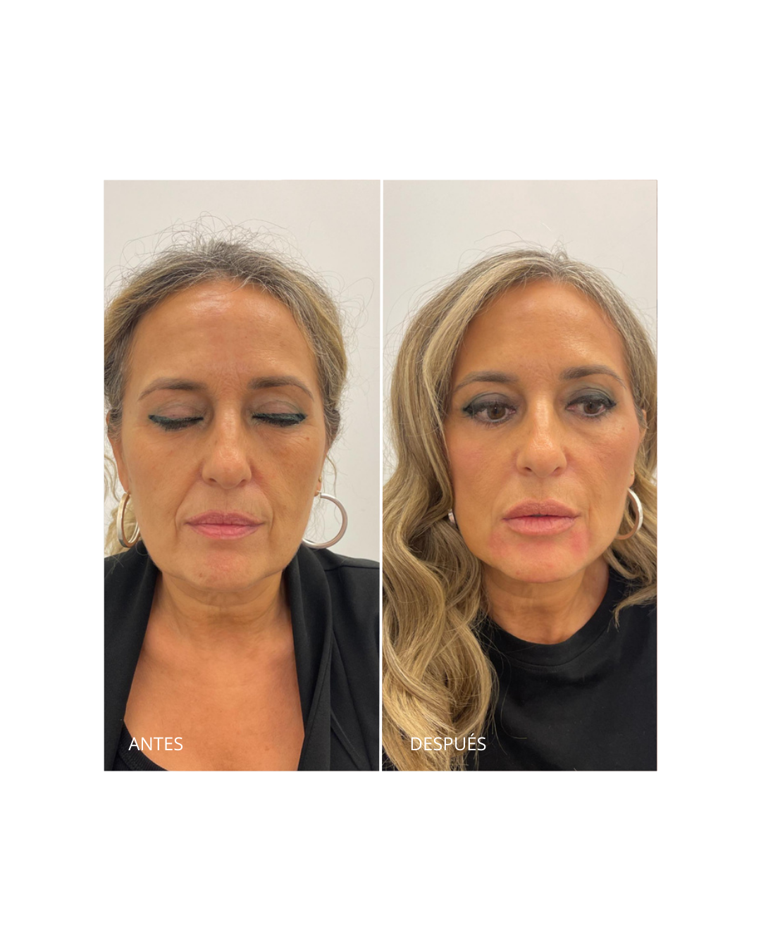 Corrección del surco nasogeniano