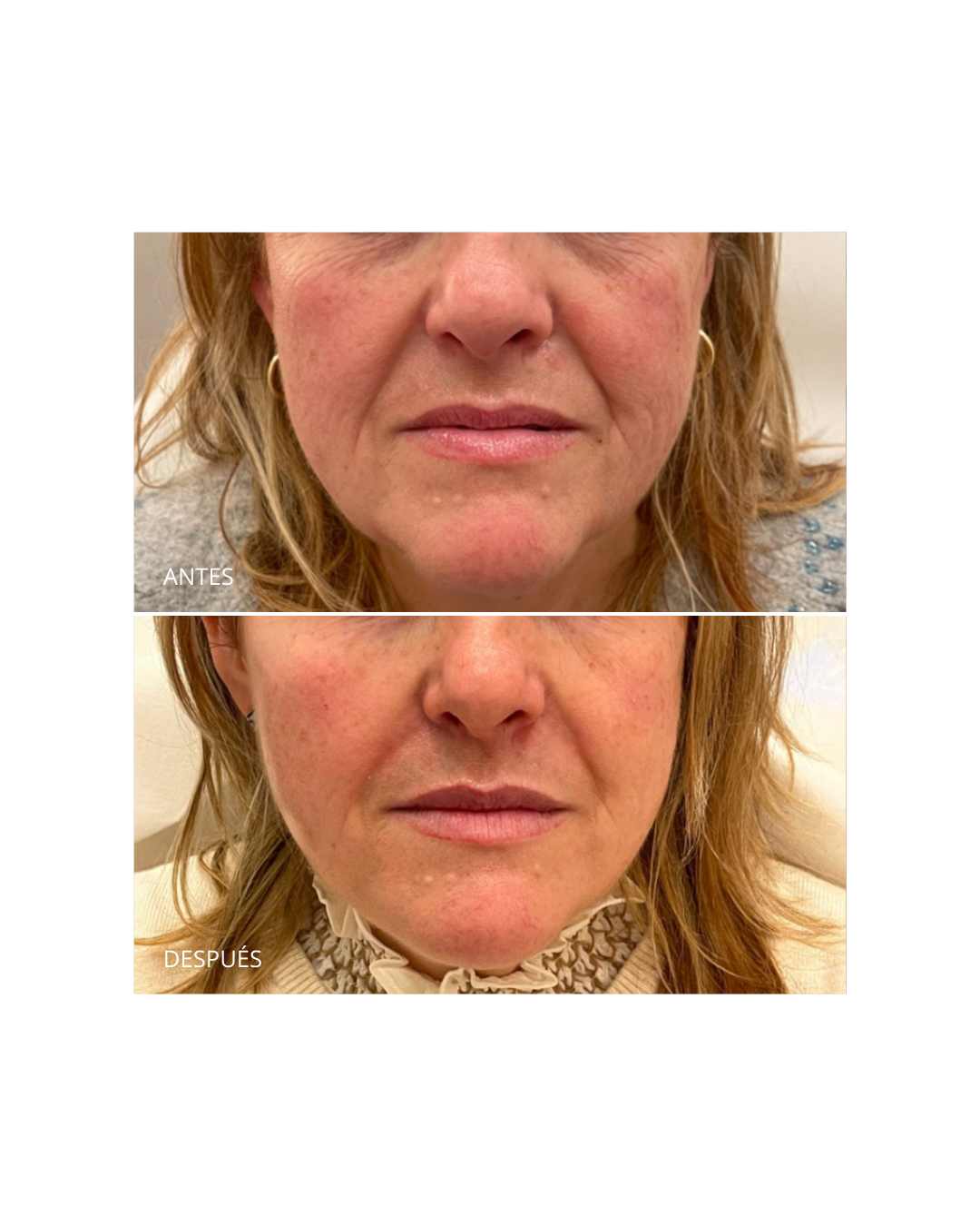 Corrección del surco nasogeniano