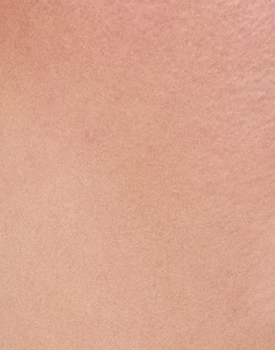 Eliminación de tatuajes