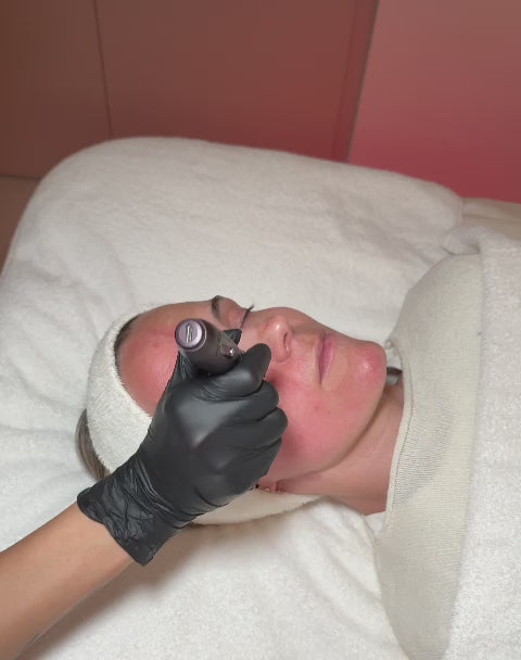 Dermapen con exososmas