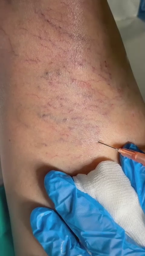 Eliminación de arañas vasculares